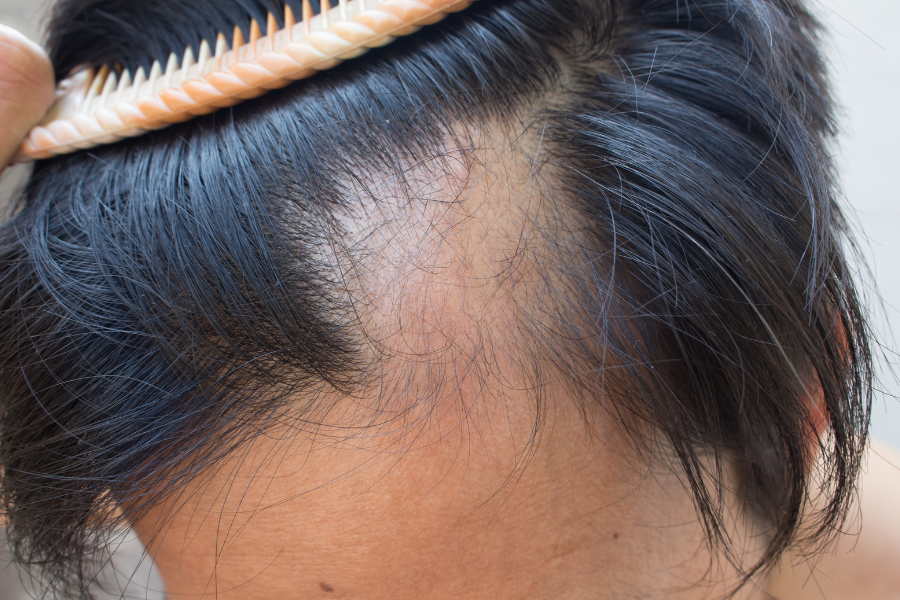 The Truth About DHT: Why Blocking it Could Be Key To Preventing Hair Loss